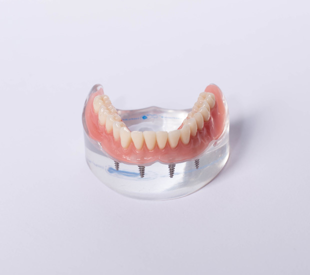 La Mesa All-on-4®