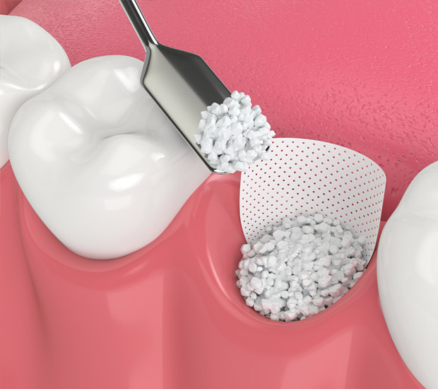 La Mesa Will I Need a Bone Graft for Dental Implants