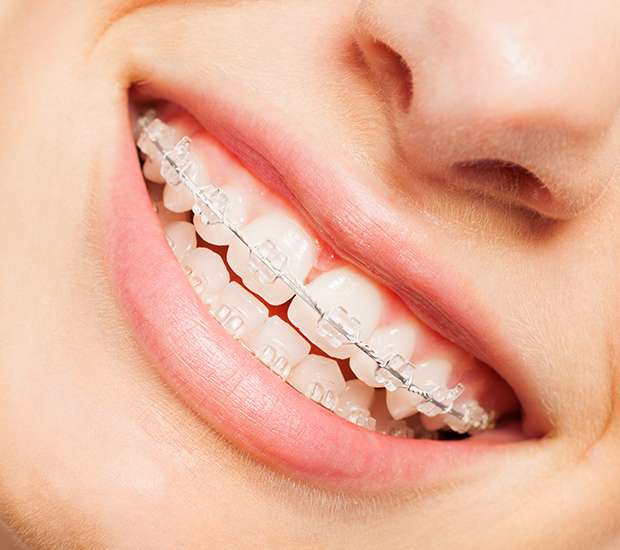 La Mesa Clear Braces