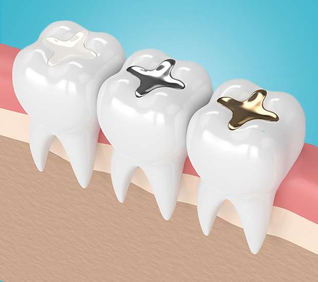 La Mesa Composite Fillings