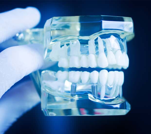 La Mesa Dental Implant Restoration