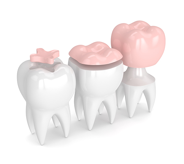 La Mesa Dental Inlays and Onlays