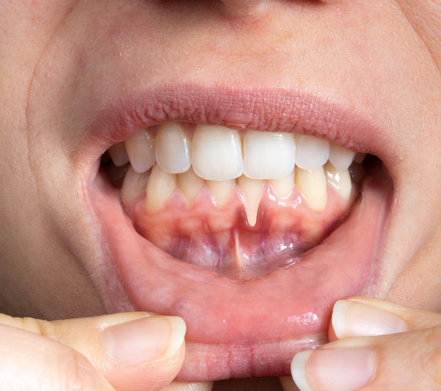 La Mesa I Think My Gums Are Receding